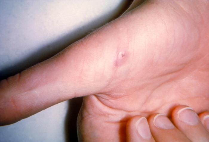 Tổn thương tại chỗ vết cào của bệnh do mèo cào (cat scratch disease)