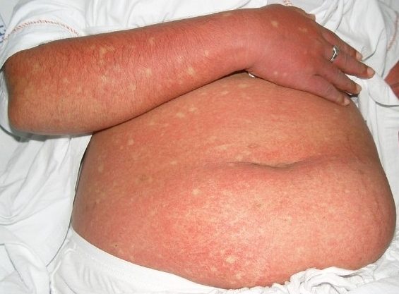 Ban đỏ và chấm xuất huyết (petechiae) trên da bệnh nhân sốt xuất huyết dengue