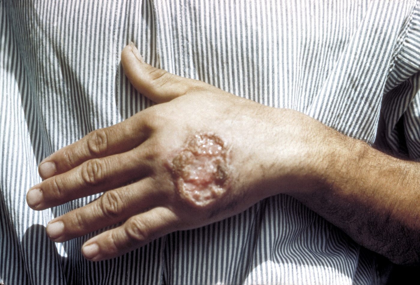 Vết loét da do Leishmania trên mu bàn tay